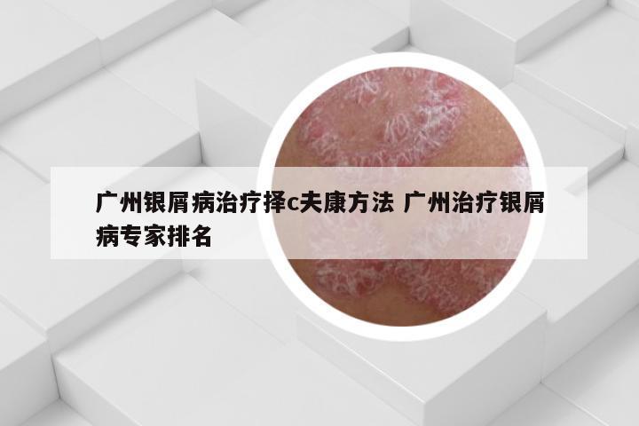 广州银屑病治疗择c夫康方法 广州治疗银屑病专家排名