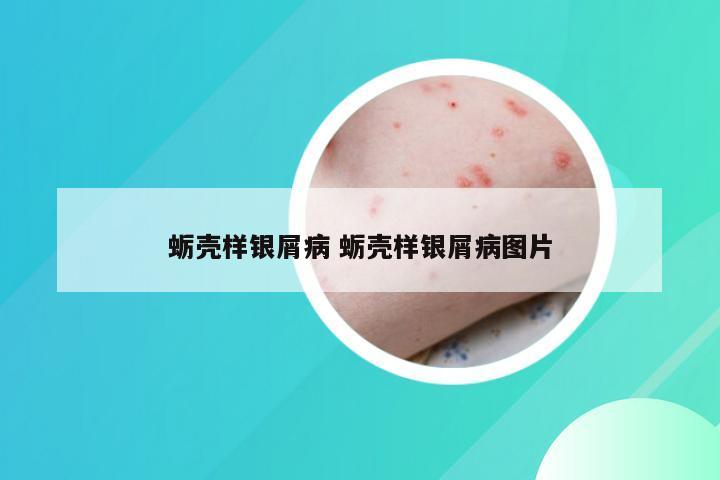 蛎壳样银屑病 蛎壳样银屑病图片