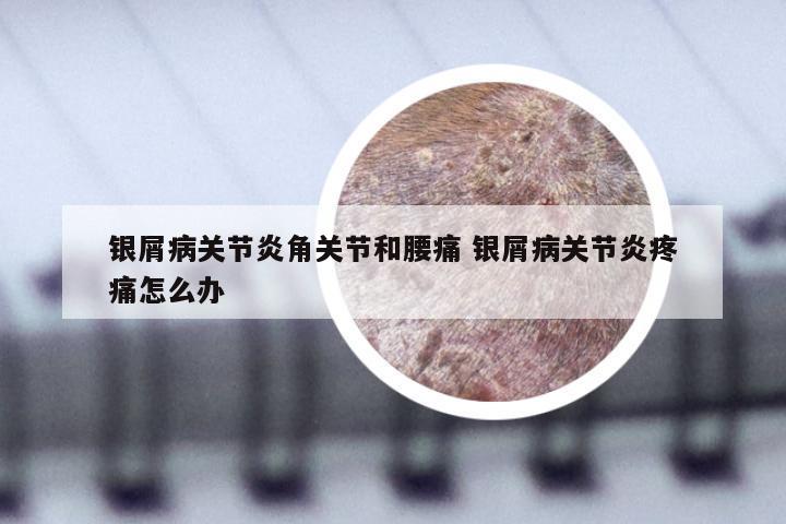 银屑病关节炎角关节和腰痛 银屑病关节炎疼痛怎么办
