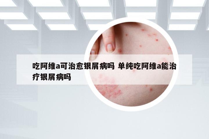 吃阿维a可治愈银屑病吗 单纯吃阿维a能治疗银屑病吗