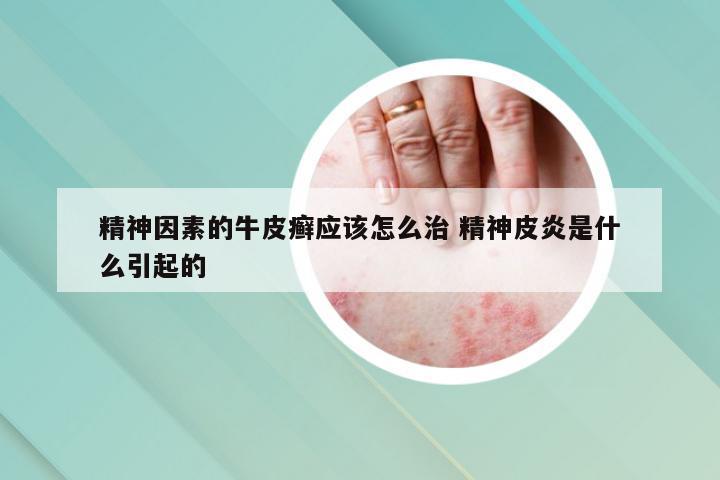 精神因素的牛皮癣应该怎么治 精神皮炎是什么引起的