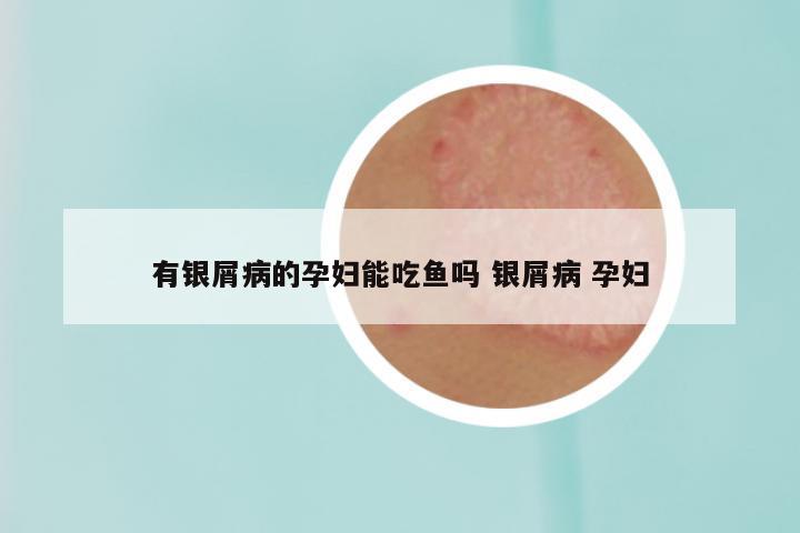 有银屑病的孕妇能吃鱼吗 银屑病 孕妇