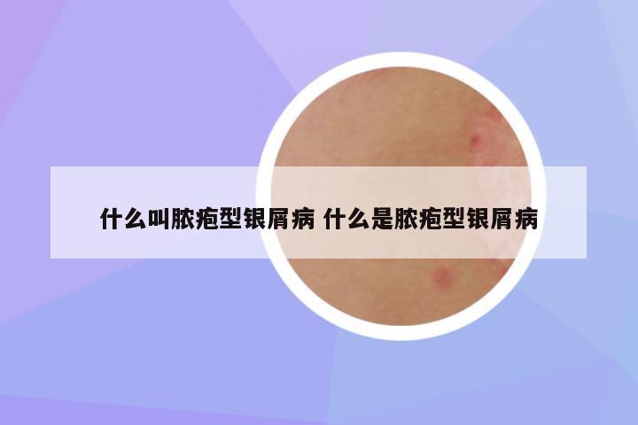 什么叫脓疱型银屑病 什么是脓疱型银屑病