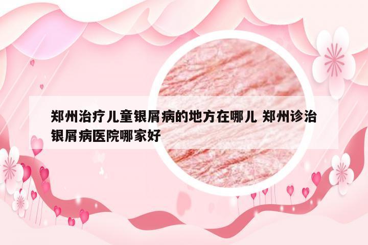 郑州治疗儿童银屑病的地方在哪儿 郑州诊治银屑病医院哪家好