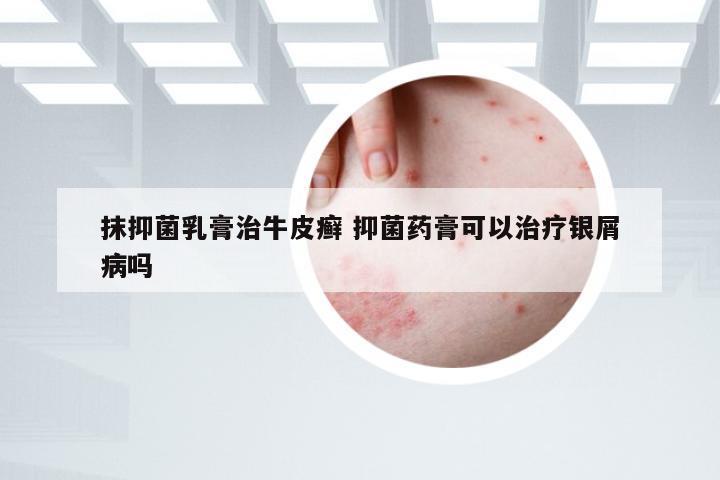 抹抑菌乳膏治牛皮癣 抑菌药膏可以治疗银屑病吗