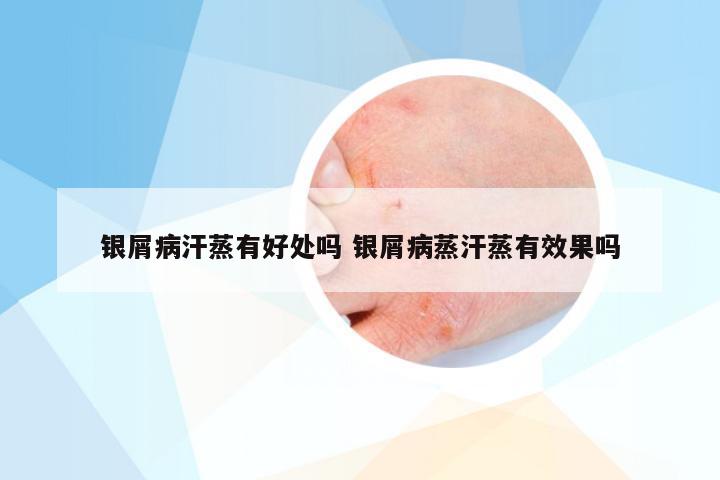 银屑病汗蒸有好处吗 银屑病蒸汗蒸有效果吗
