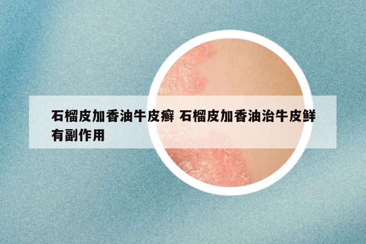 石榴皮加香油牛皮癣 石榴皮加香油治牛皮鲜有副作用