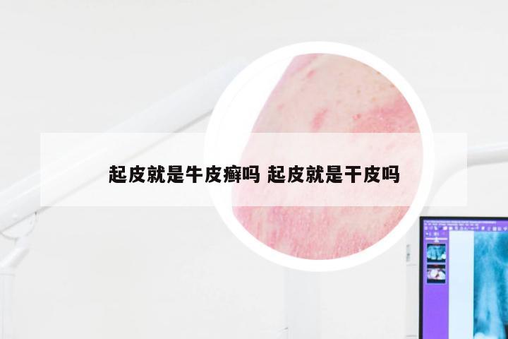 起皮就是牛皮癣吗 起皮就是干皮吗