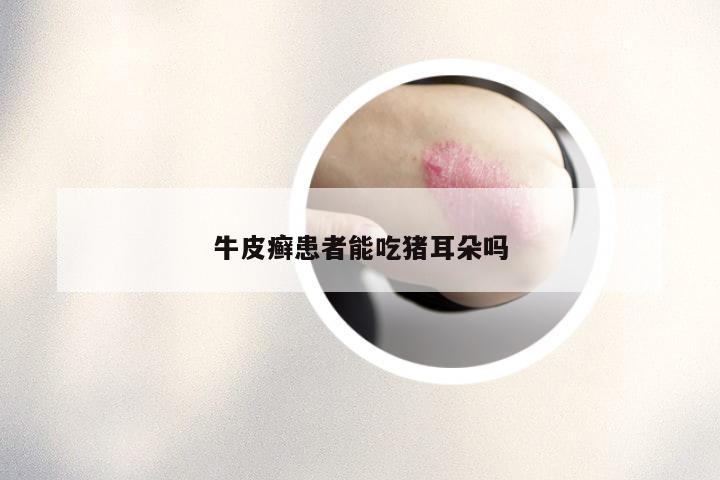 牛皮癣患者能吃猪耳朵吗