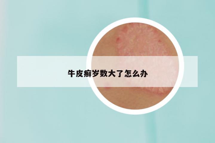 牛皮癣岁数大了怎么办