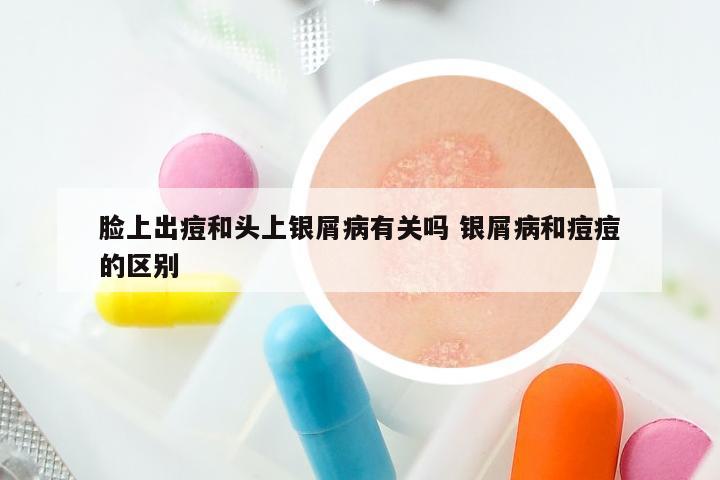 脸上出痘和头上银屑病有关吗 银屑病和痘痘的区别