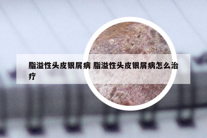 脂溢性头皮银屑病 脂溢性头皮银屑病怎么治疗