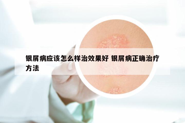 银屑病应该怎么样治效果好 银屑病正确治疗方法