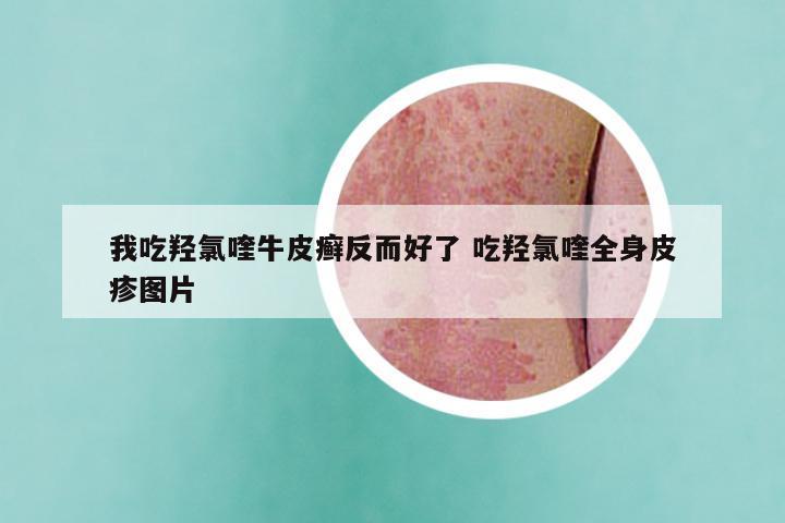 我吃羟氯喹牛皮癣反而好了 吃羟氯喹全身皮疹图片