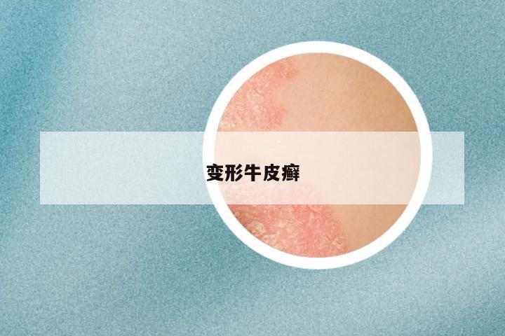 变形牛皮癣