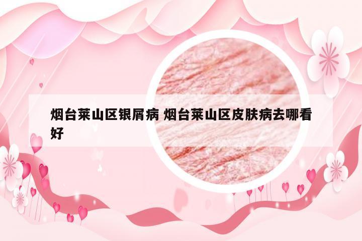 烟台莱山区银屑病 烟台莱山区皮肤病去哪看好