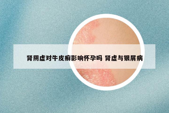 肾阴虚对牛皮癣影响怀孕吗 肾虚与银屑病