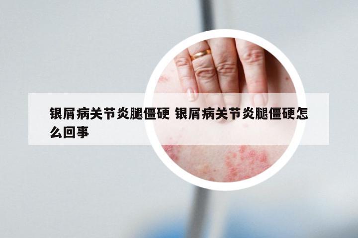 银屑病关节炎腿僵硬 银屑病关节炎腿僵硬怎么回事