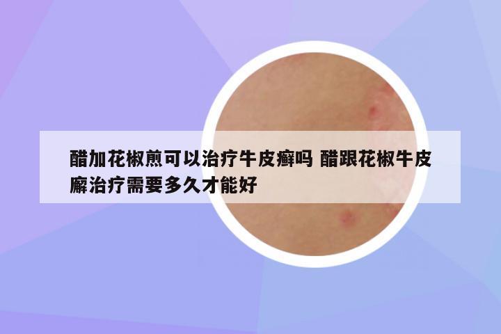 醋加花椒煎可以治疗牛皮癣吗 醋跟花椒牛皮廨治疗需要多久才能好