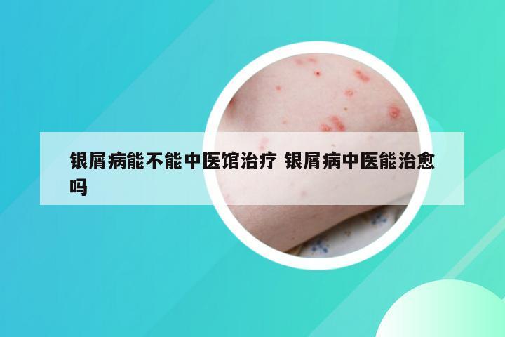 银屑病能不能中医馆治疗 银屑病中医能治愈吗