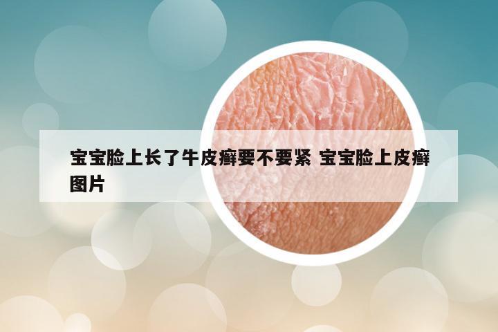 宝宝脸上长了牛皮癣要不要紧 宝宝脸上皮癣图片