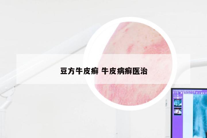 豆方牛皮癣 牛皮病癣医治