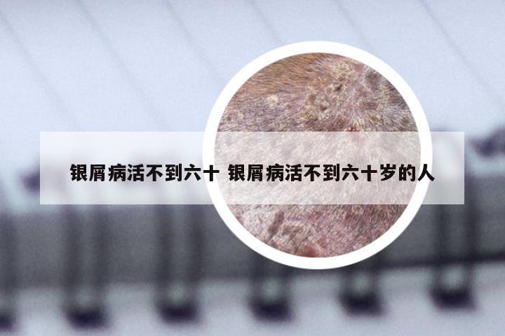 银屑病活不到六十 银屑病活不到六十岁的人