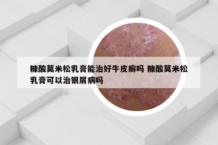 糠酸莫米松乳膏能治好牛皮癣吗 糠酸莫米松乳膏可以治银屑病吗