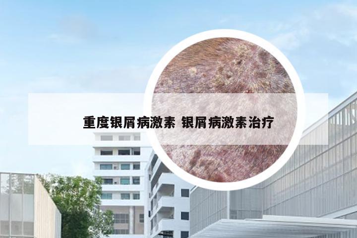 重度银屑病激素 银屑病激素治疗