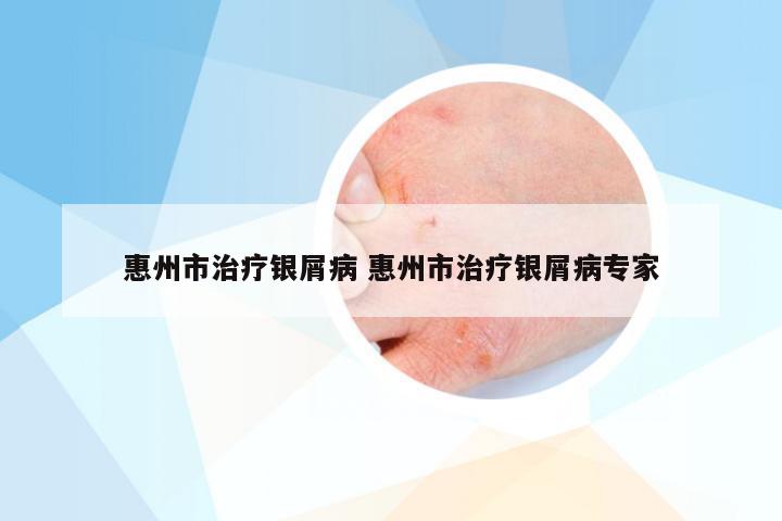 惠州市治疗银屑病 惠州市治疗银屑病专家