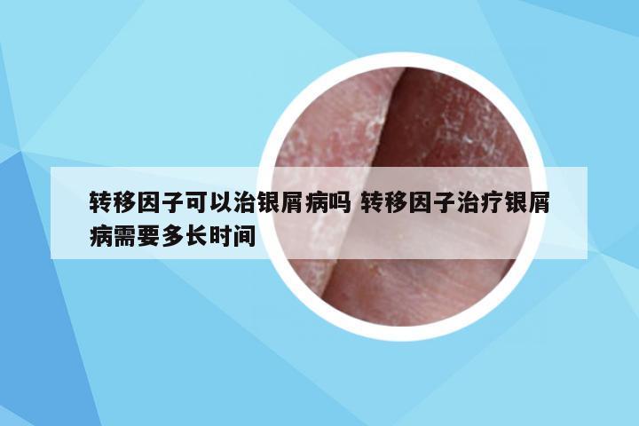 转移因子可以治银屑病吗 转移因子治疗银屑病需要多长时间
