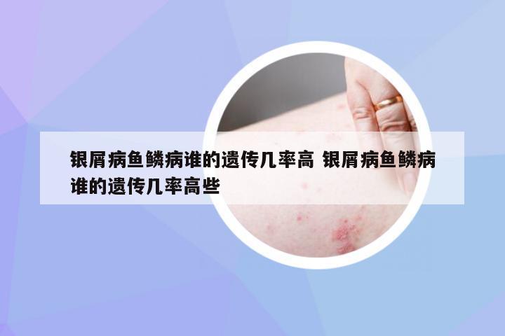银屑病鱼鳞病谁的遗传几率高 银屑病鱼鳞病谁的遗传几率高些