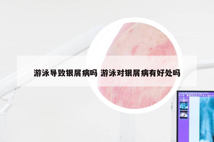 游泳导致银屑病吗 游泳对银屑病有好处吗