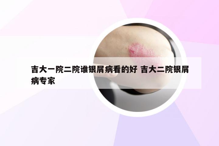 吉大一院二院谁银屑病看的好 吉大二院银屑病专家