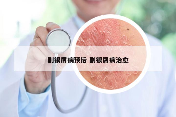 副银屑病预后 副银屑病治愈