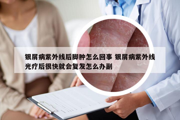 银屑病紫外线后脚肿怎么回事 银屑病紫外线光疗后很快就会复发怎么办副