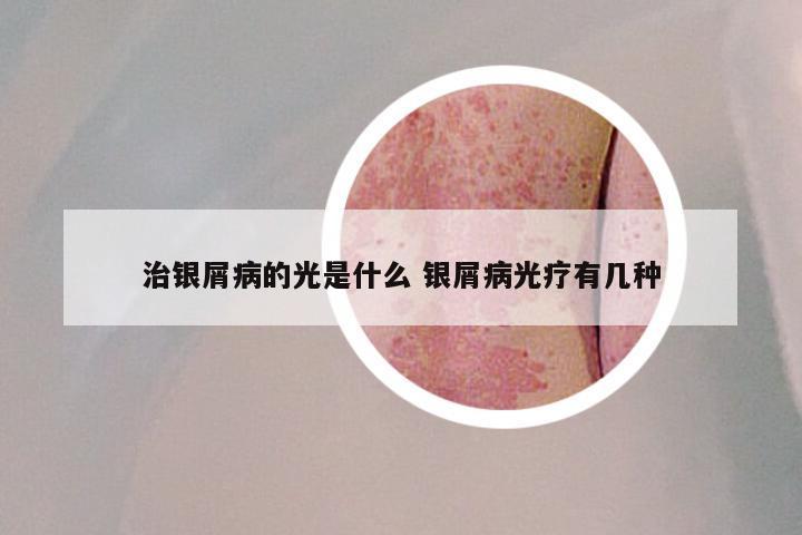 治银屑病的光是什么 银屑病光疗有几种