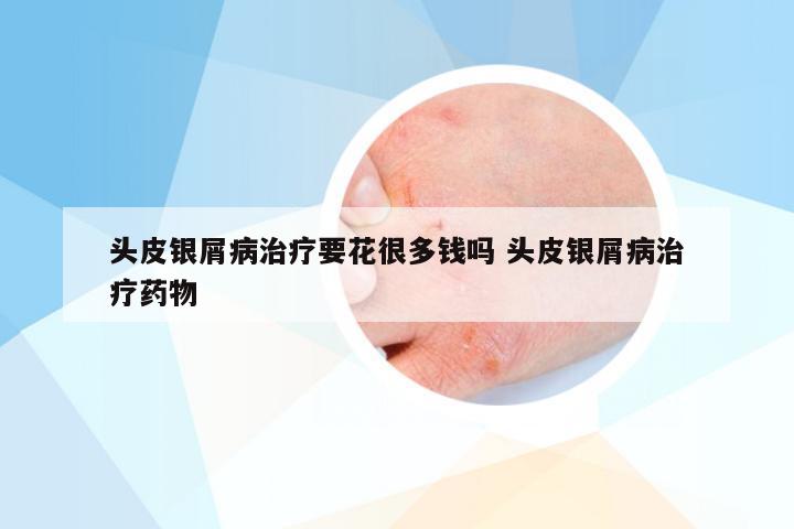 头皮银屑病治疗要花很多钱吗 头皮银屑病治疗药物
