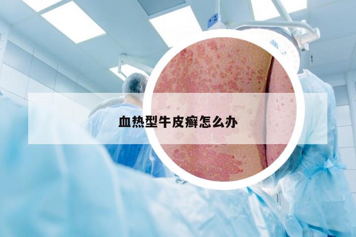 血热型牛皮癣怎么办