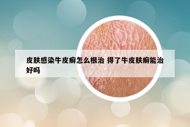 皮肤感染牛皮癣怎么根治 得了牛皮肤癣能治好吗
