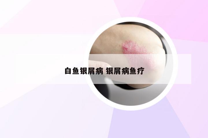 白鱼银屑病 银屑病鱼疗