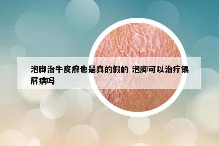 泡脚治牛皮癣也是真的假的 泡脚可以治疗银屑病吗