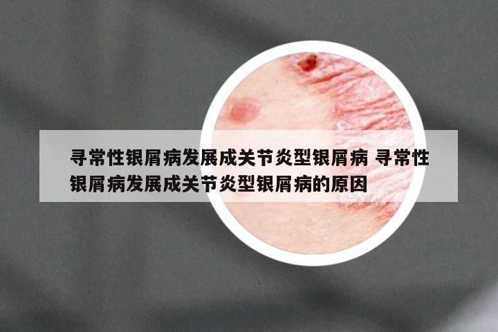 寻常性银屑病发展成关节炎型银屑病 寻常性银屑病发展成关节炎型银屑病的原因