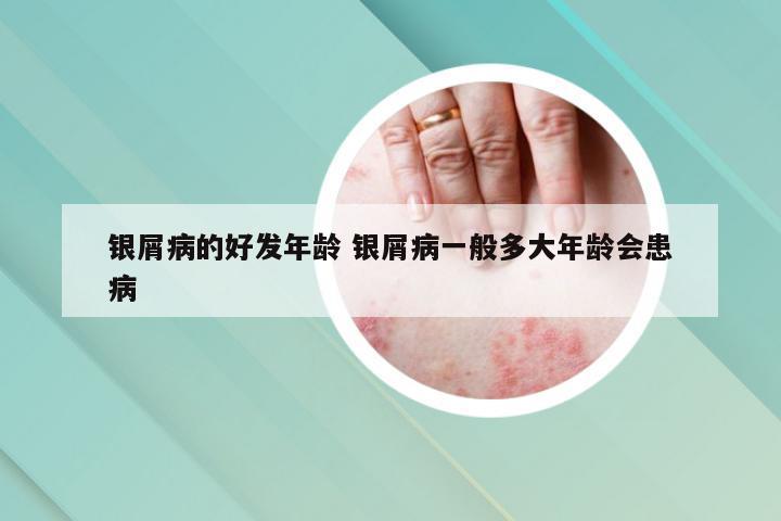 银屑病的好发年龄 银屑病一般多大年龄会患病