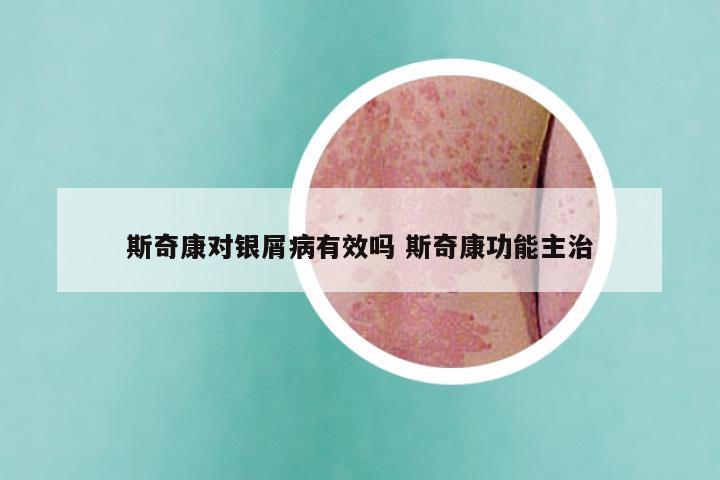 斯奇康对银屑病有效吗 斯奇康功能主治