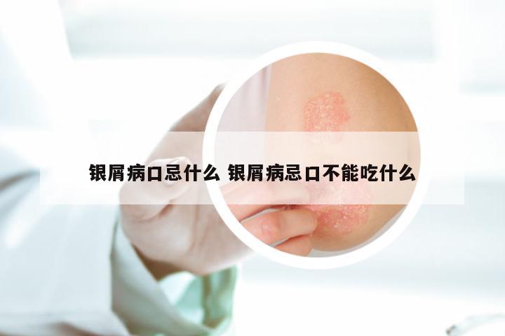 银屑病口忌什么 银屑病忌口不能吃什么