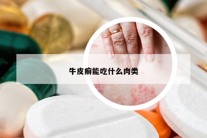 牛皮癣能吃什么肉类