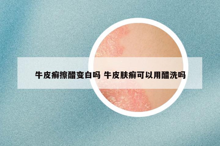 牛皮癣擦醋变白吗 牛皮肤癣可以用醋洗吗