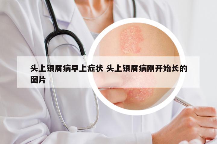 头上银屑病早上症状 头上银屑病刚开始长的图片