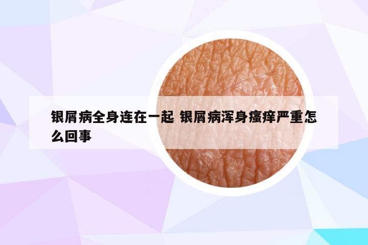银屑病全身连在一起 银屑病浑身瘙痒严重怎么回事